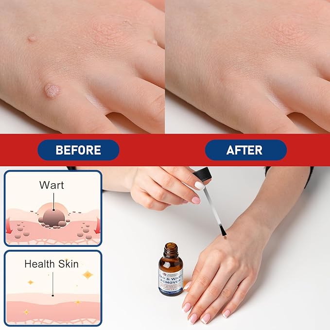 15ML Skin Tag Removal Kit, at-home Callus-1112-A6