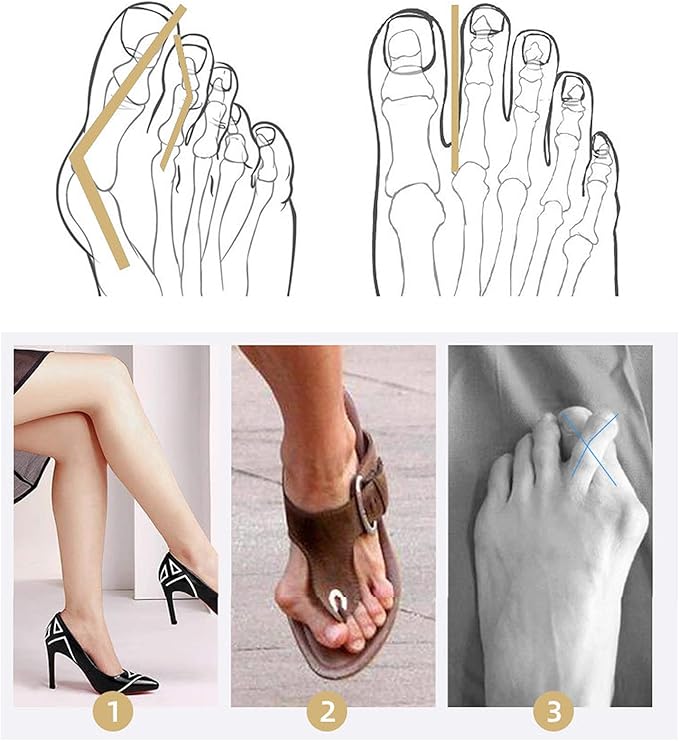 2 Pair Bunion Corrector Pads