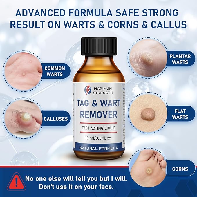15ML Skin Tag Removal Kit, at-home Callus-1112-A6